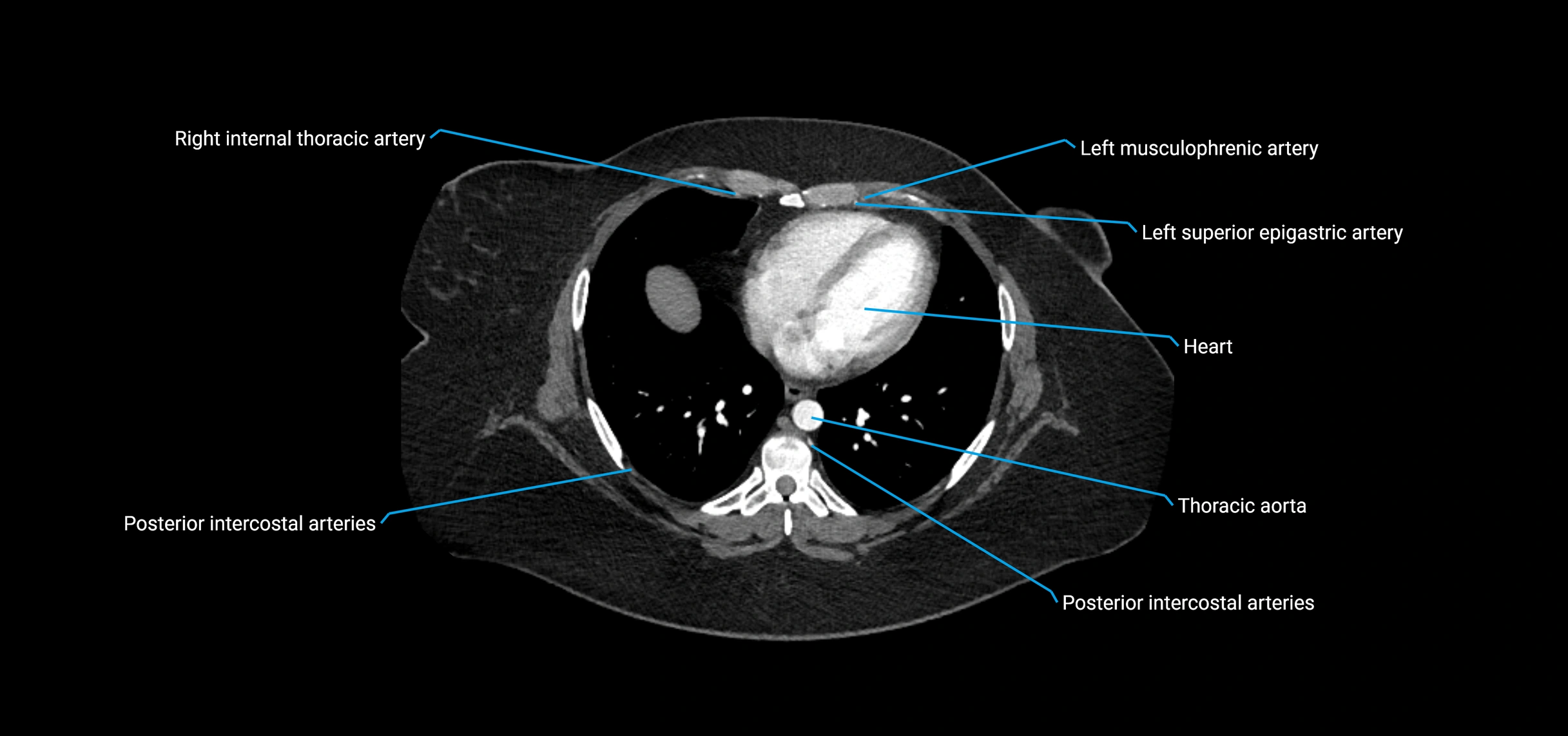 CTA abdomen axial cross sectional anatomy labelled image_4 (2).webp